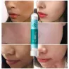Acne treatment - blackhead remover - brightening mask with hyaluronic acid snail essence 10 piecesSkin